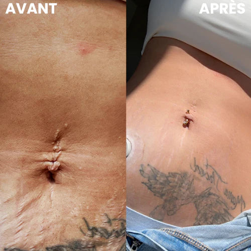Ceinture Lumière Rouge – Raffermissez, tonifiez et retrouvez confiance
