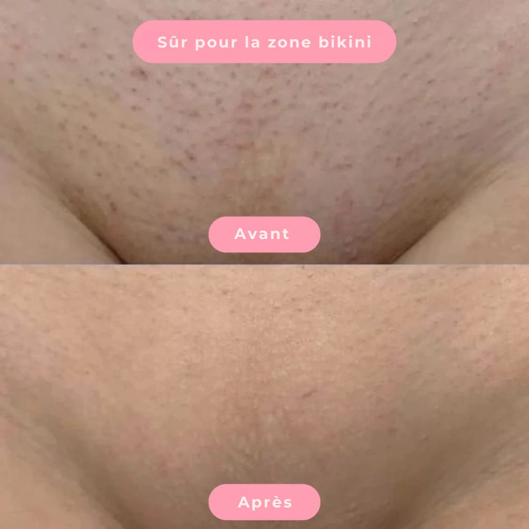 Épilateur LisseSkin – Douceur instantanée, sans douleur