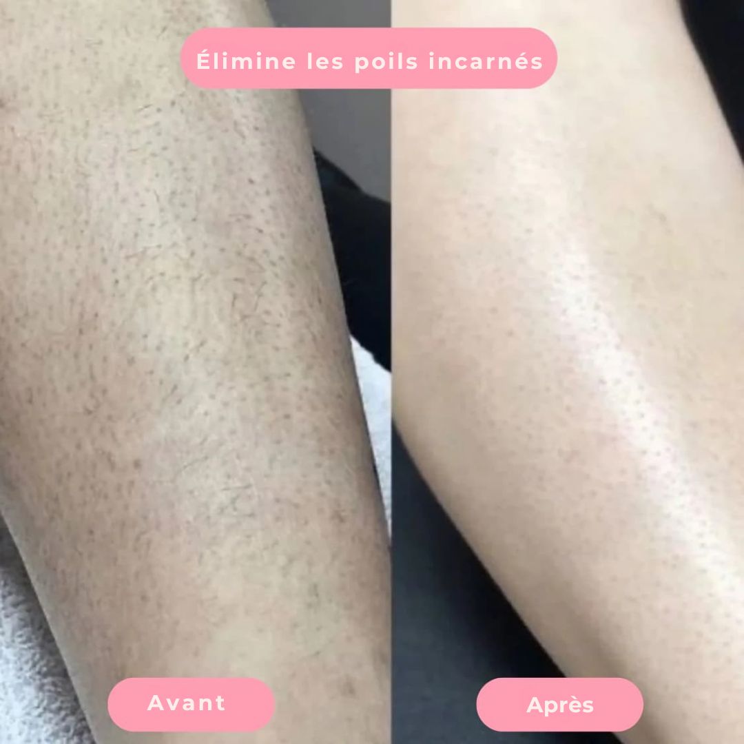 Épilateur LisseSkin – Douceur instantanée, sans douleur